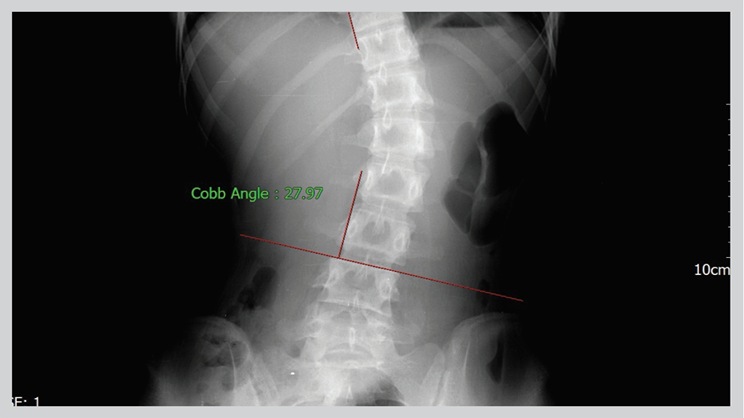 Cobb angle of Scoliosis(LT,RT)
